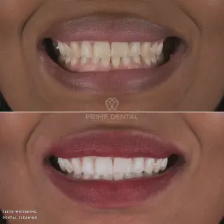 /img/27015-dental-whitening-aftercare.webp