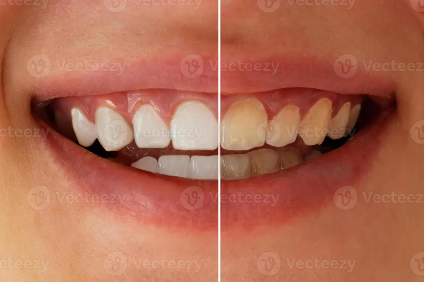 27015 dental whitening before after results