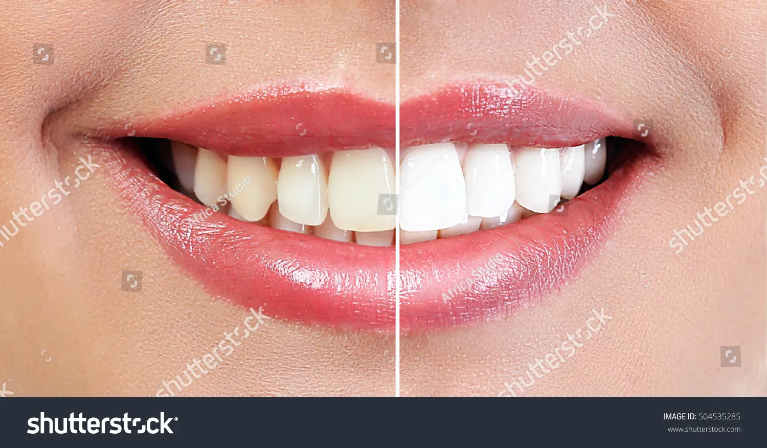 27015 dental whitening sensitivity