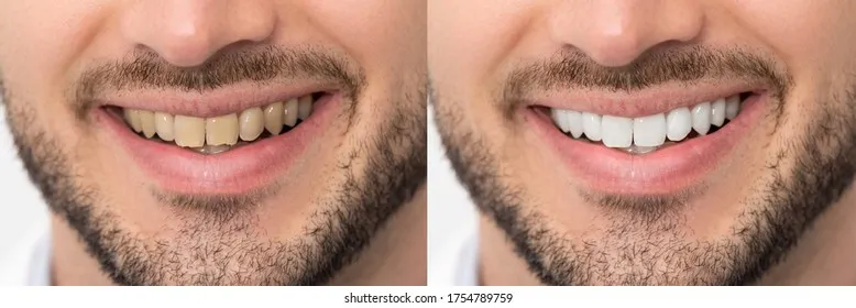 27015 in office teeth whitening