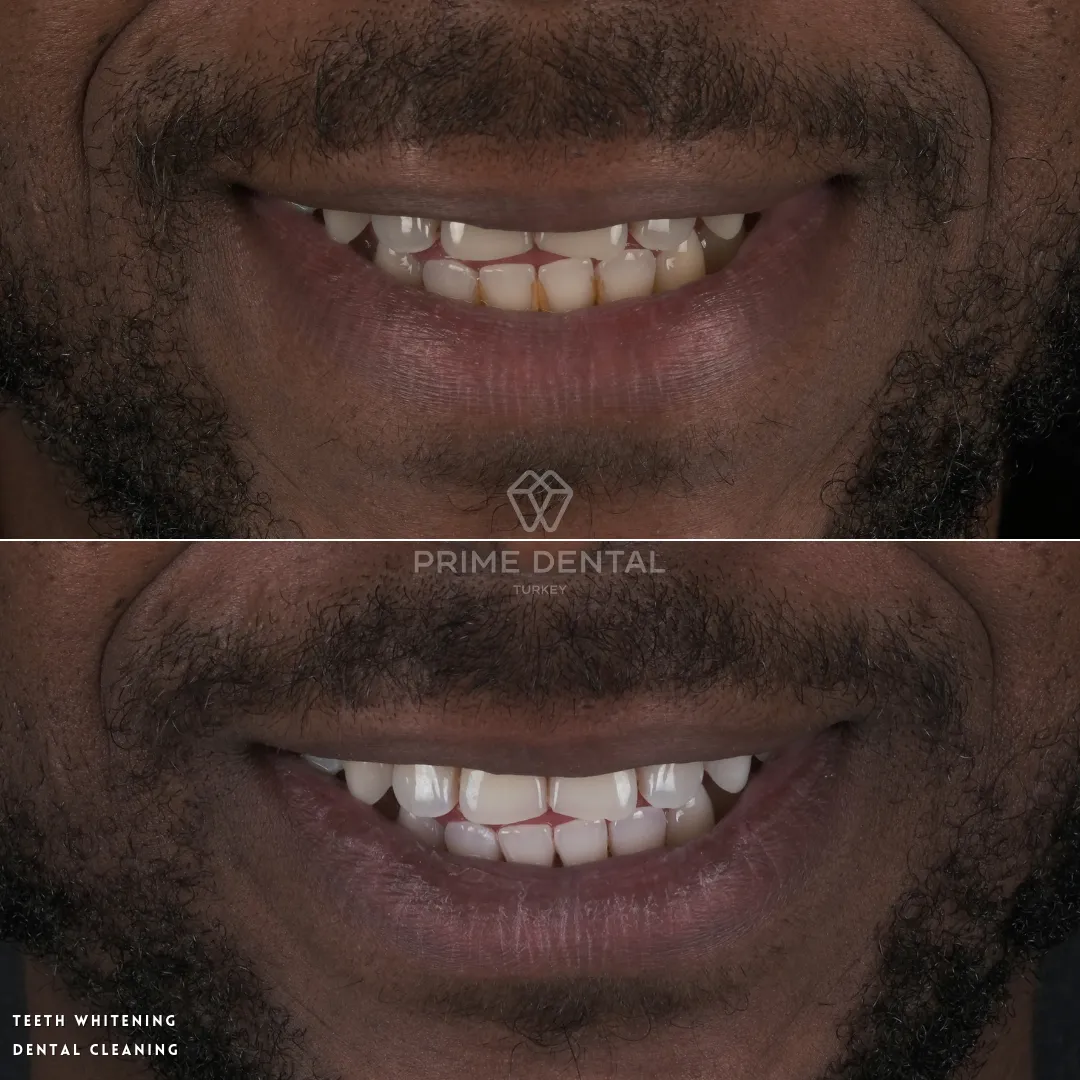 27015 teeth whitening candidate