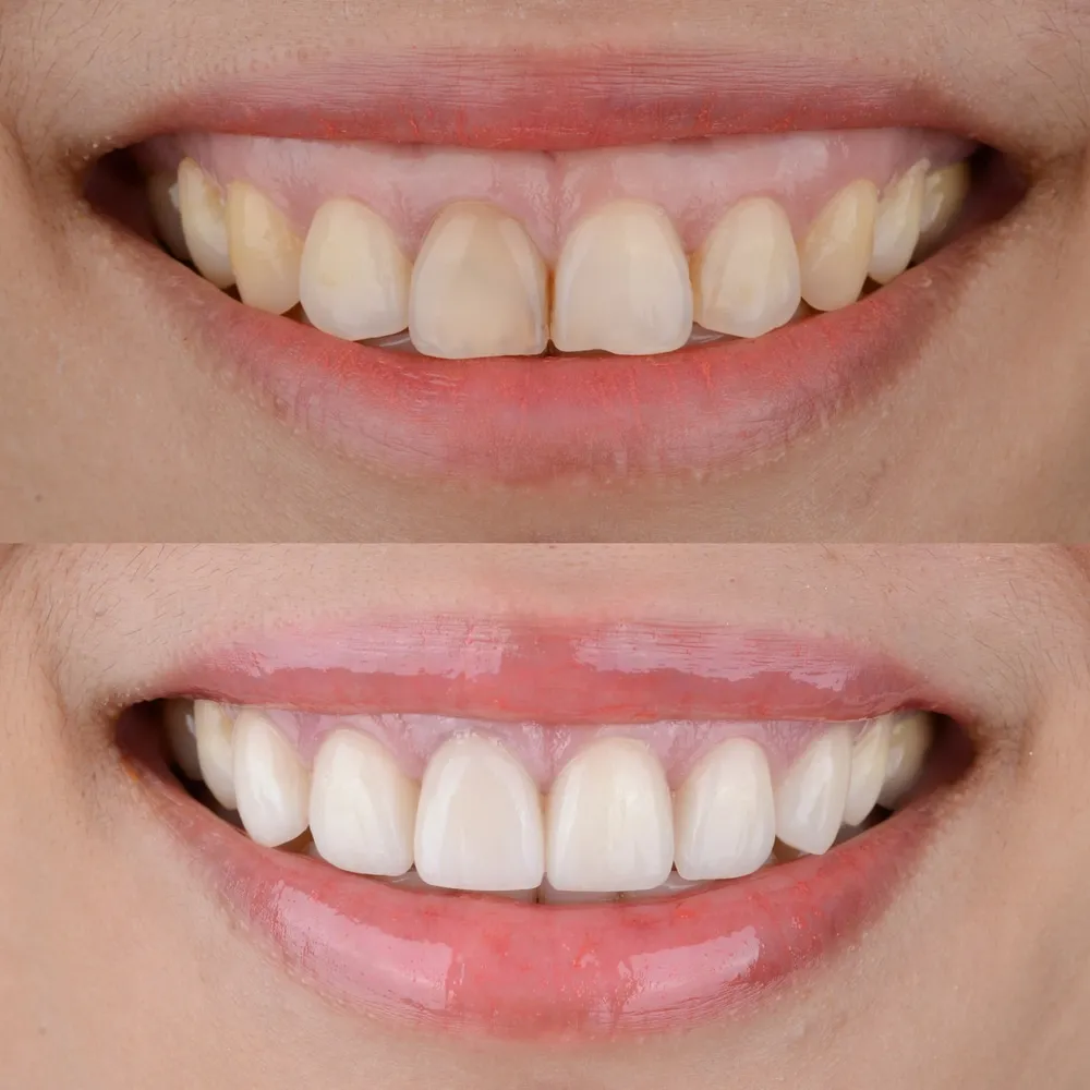 27017 teeth whitening foods