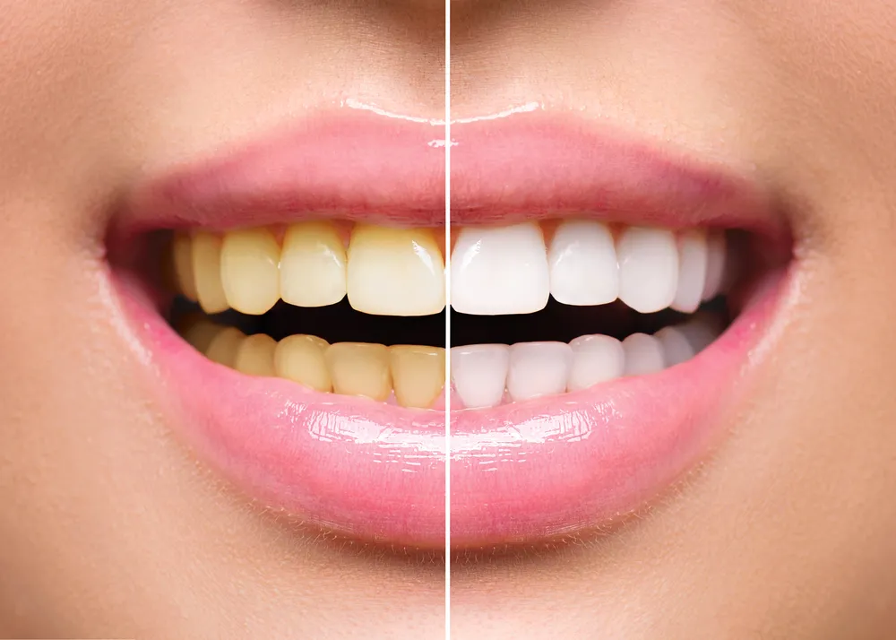 /img/27017-things-to-avoid-after-whitening.webp