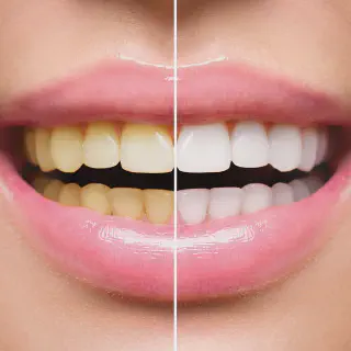 /img/27017-things-to-avoid-after-whitening.webp
