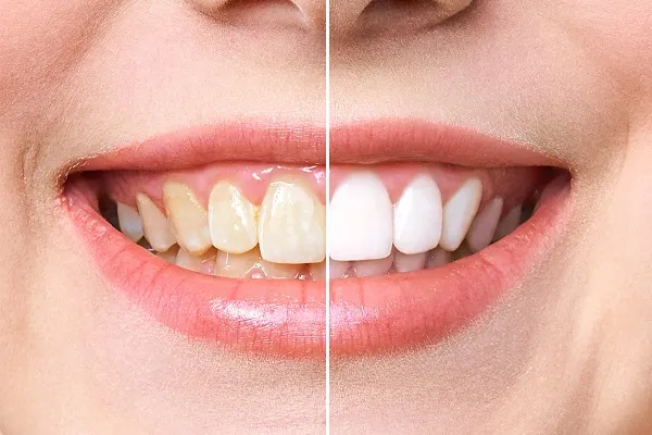 27019 professional teeth whitening