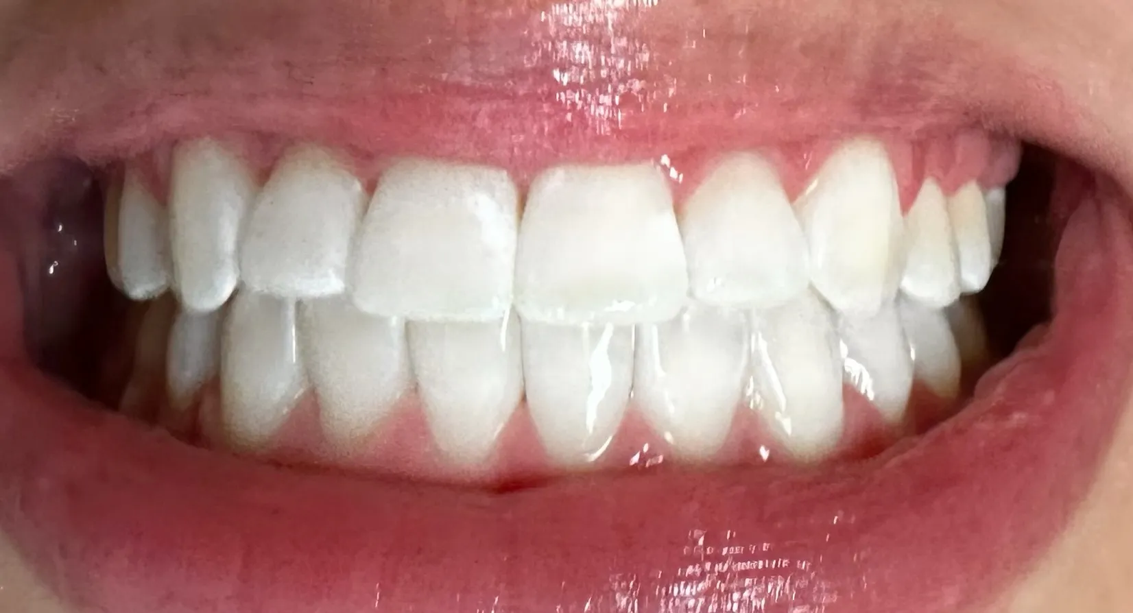 27019 teeth sensitivity