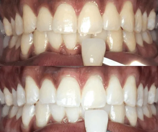 27019 teeth stains