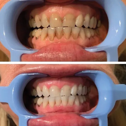 /img/27023-maintain-oral-hygiene.webp