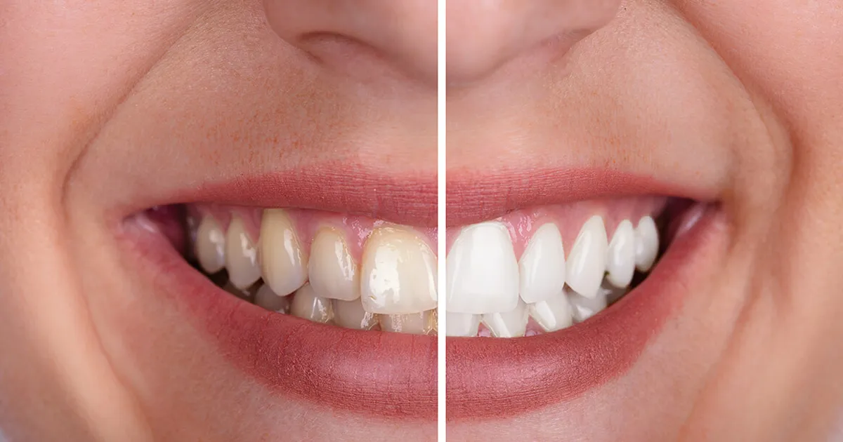 27029 teeth whitening cons