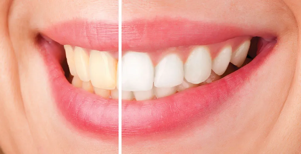 27029 teeth whitening pros