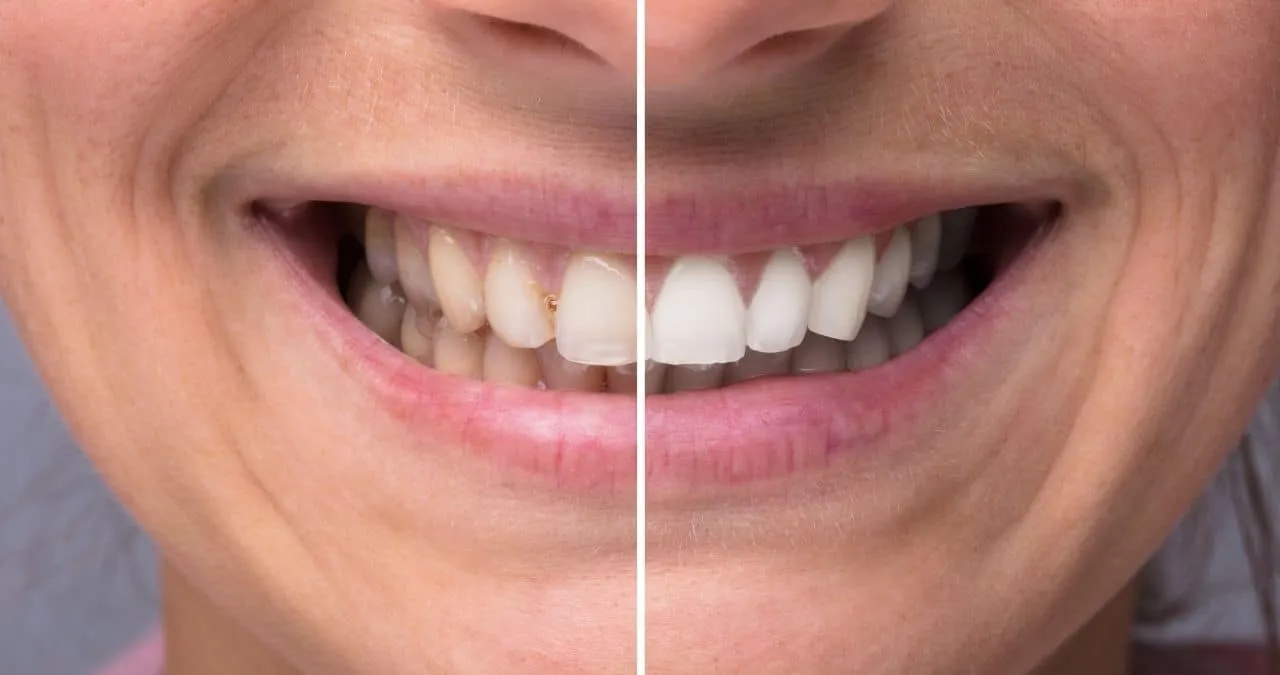 27029 teeth whitening sensitivity