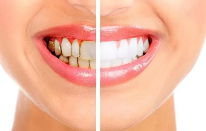 27030 professional teeth whitening