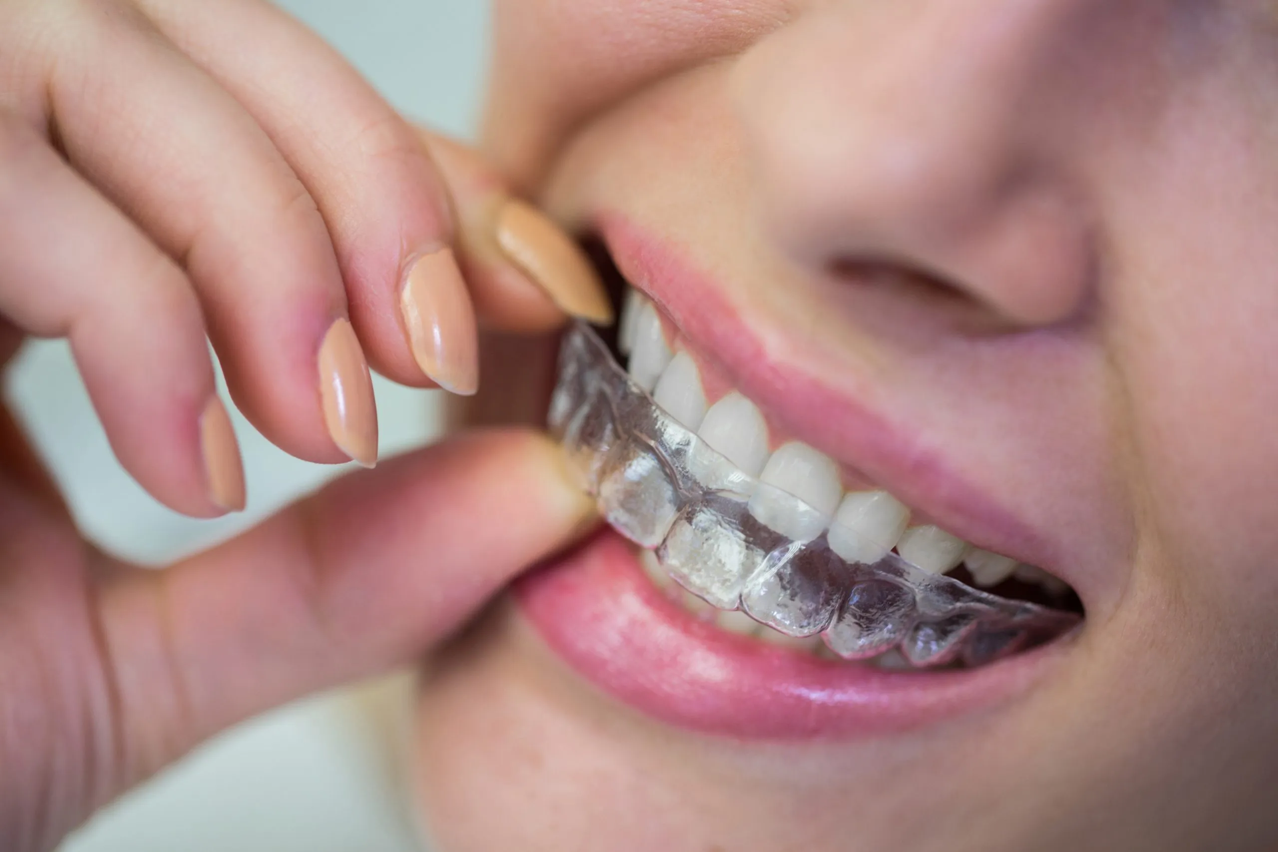 27033 teeth whitening maplewood mn checkup