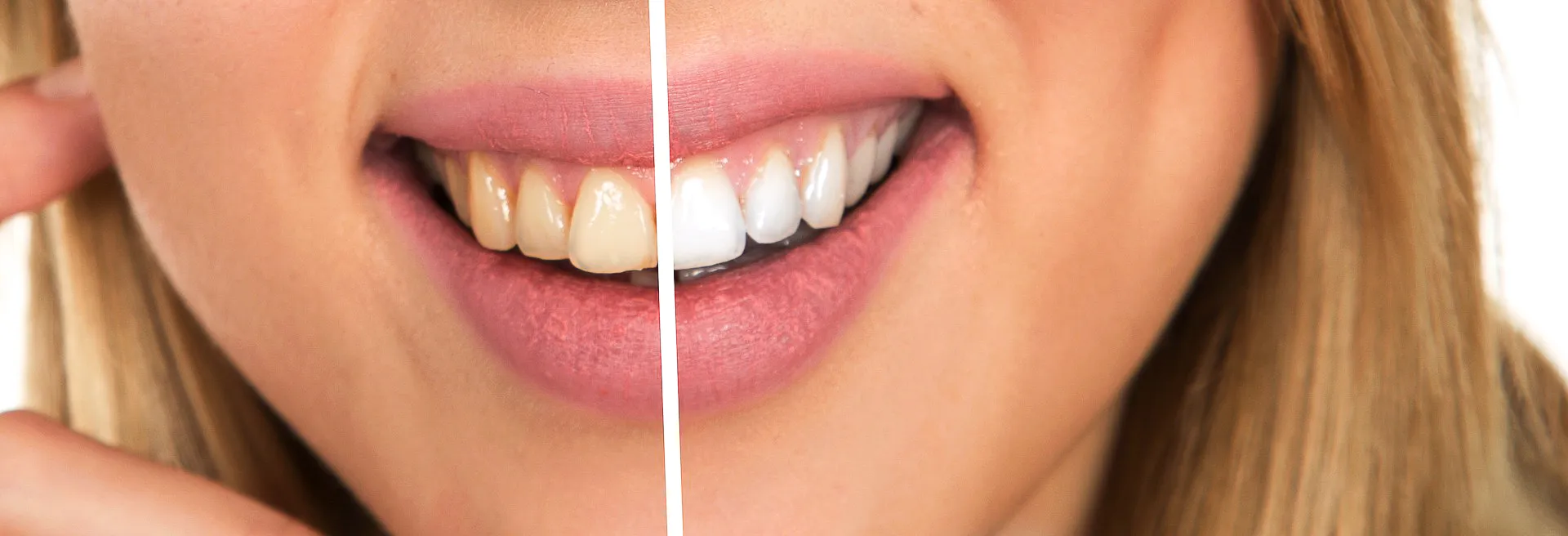 /img/27033-teeth-whitening-maplewood-mn-maintaining.webp