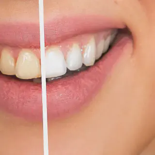 /img/27033-teeth-whitening-maplewood-mn-maintaining.webp