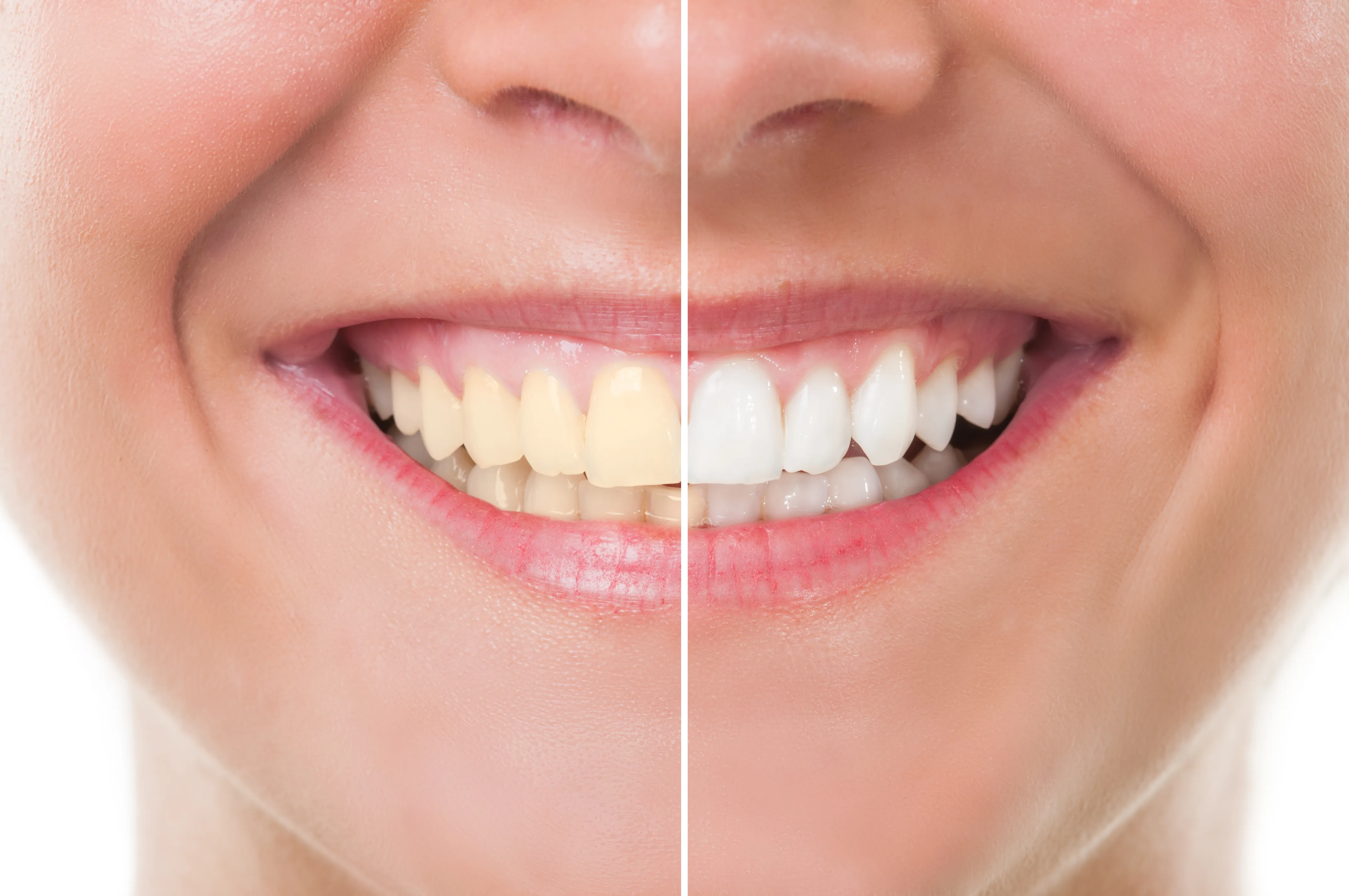 27033 teeth whitening maplewood mn professional