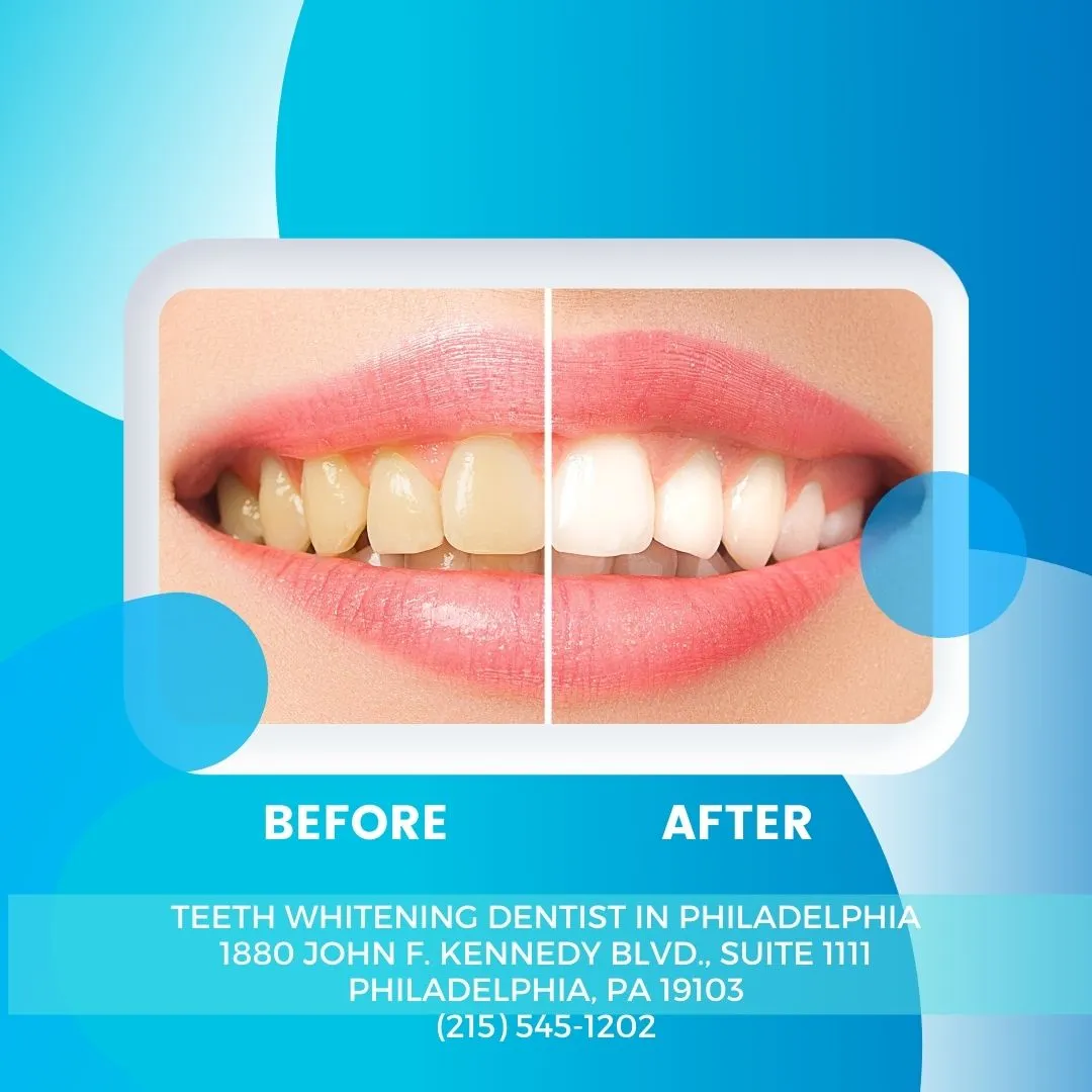 27034 teeth whitening philly 5