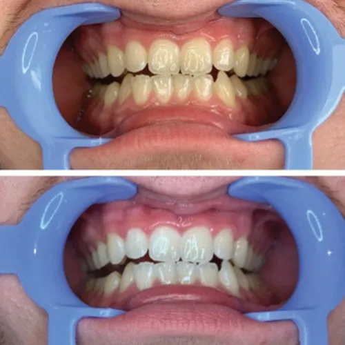 27035 lavinso teeth whitening faster results