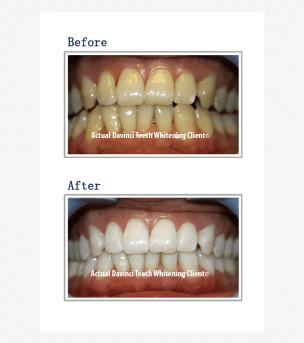 27035 lavinso teeth whitening long lasting