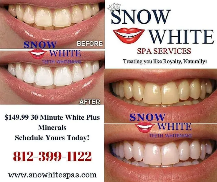 27035 lavinso teeth whitening unique formula