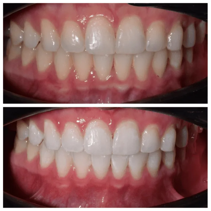 27039 gum irritation after whitening