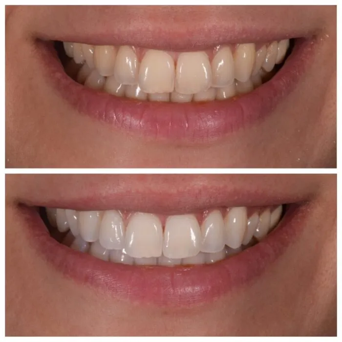 27039 sore throat after whitening
