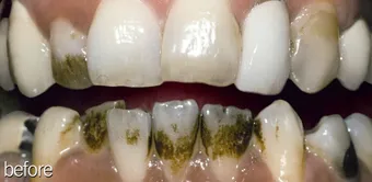 27053 immediate risks teeth whitening