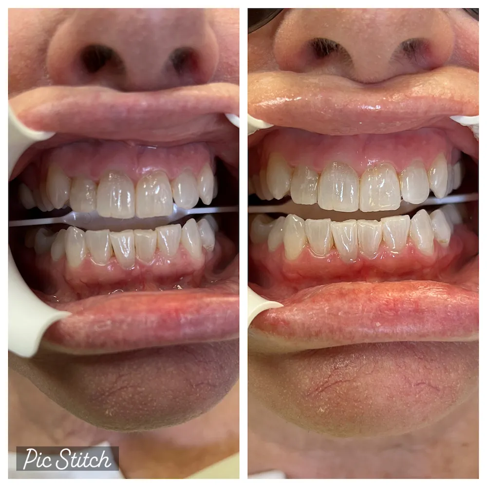 27055 teeth whitening diet