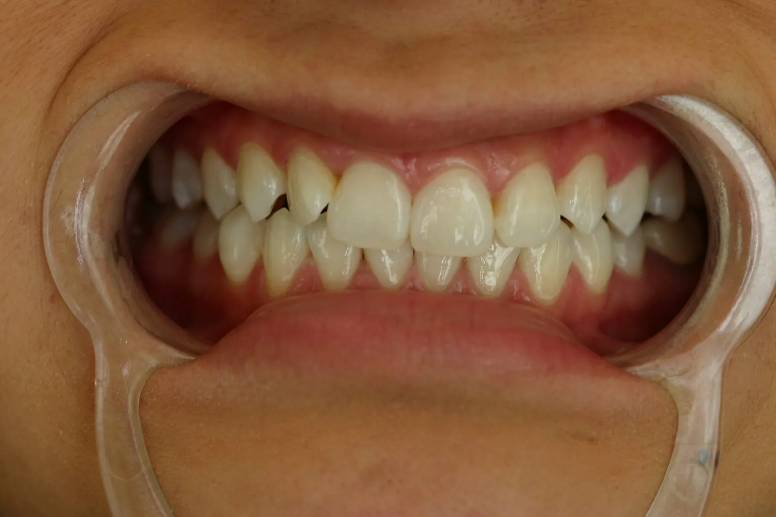 /img/27059-teeth-whitening-conclusion.webp