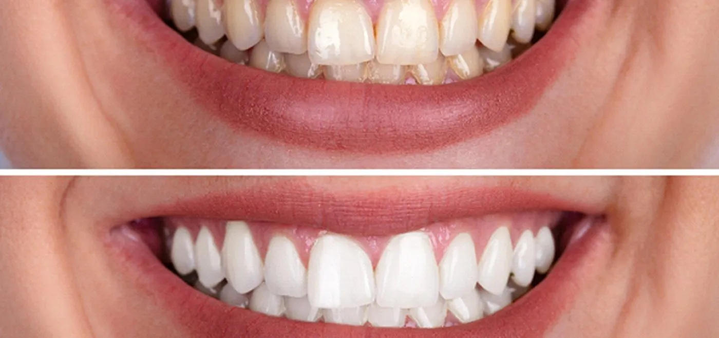 27062 at home teeth whitening