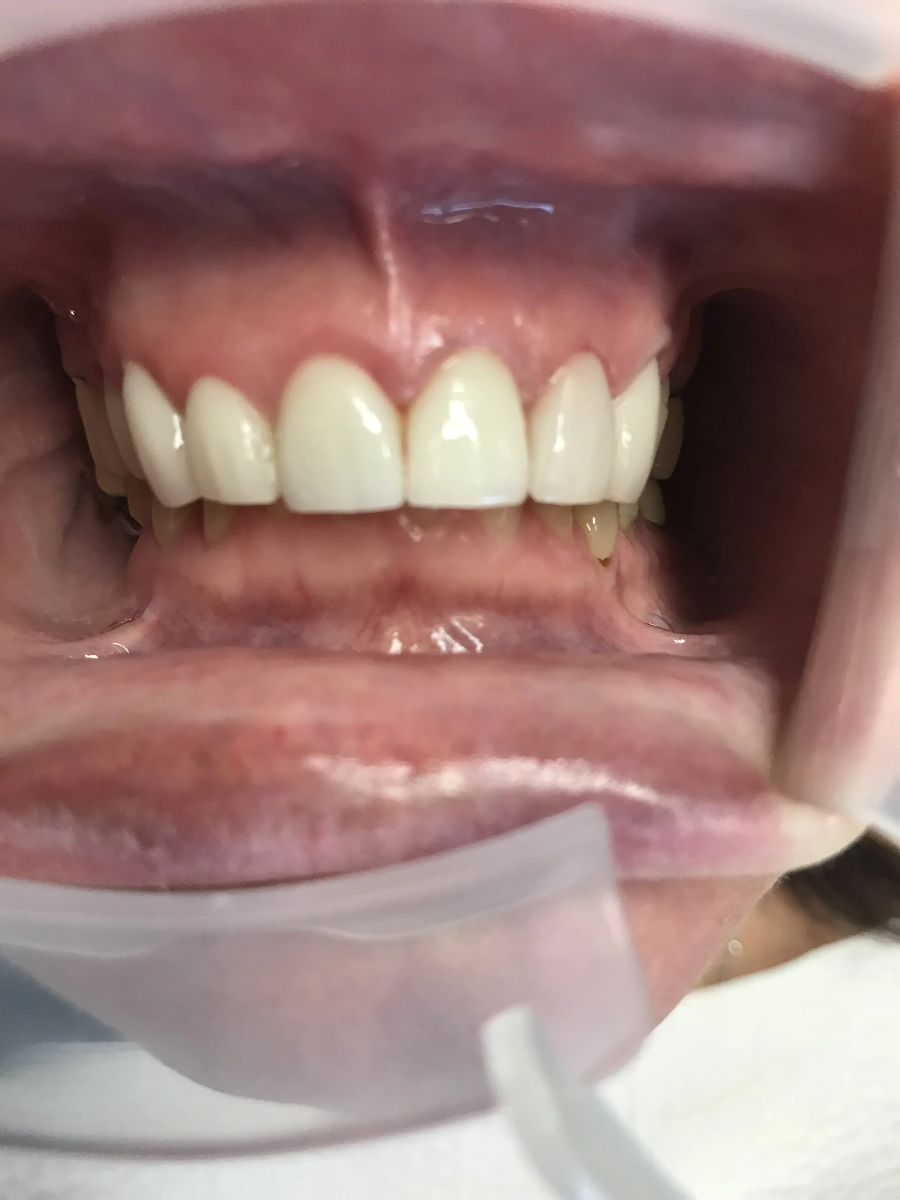 27067 teeth whitening keswick image3