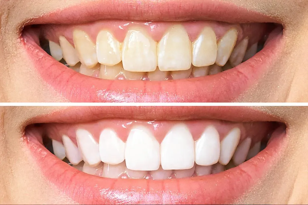 27072 teeth sensitivity