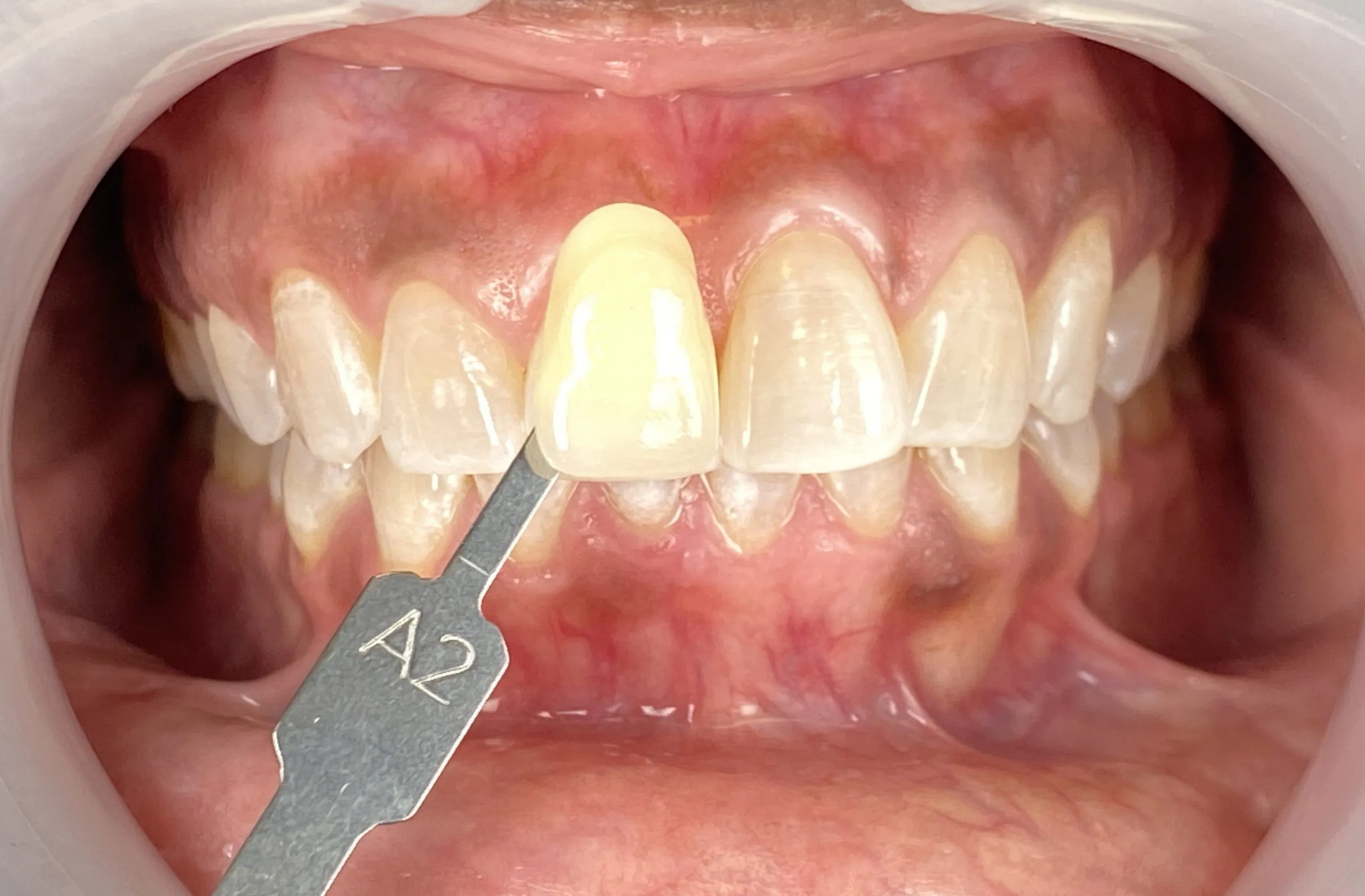 27074 teeth whitening northern kentucky image5