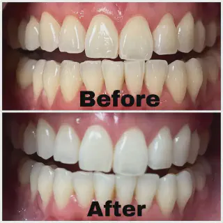 /img/27075-teeth-whitening-marina-sf-maintenance.webp
