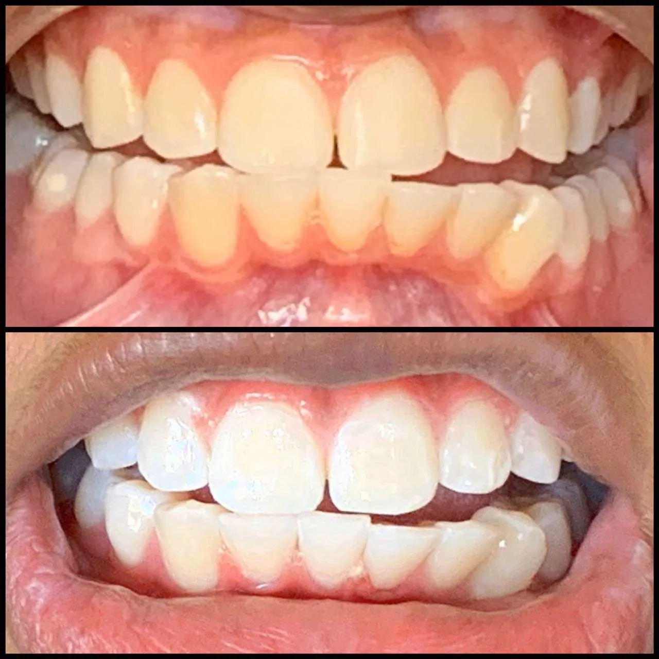 27075 teeth whitening marina sf stain removal