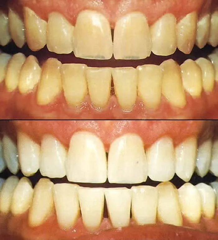 27077 teeth whitening options