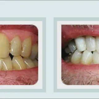 /img/27085-teeth-whitening-procedures-dentist.webp