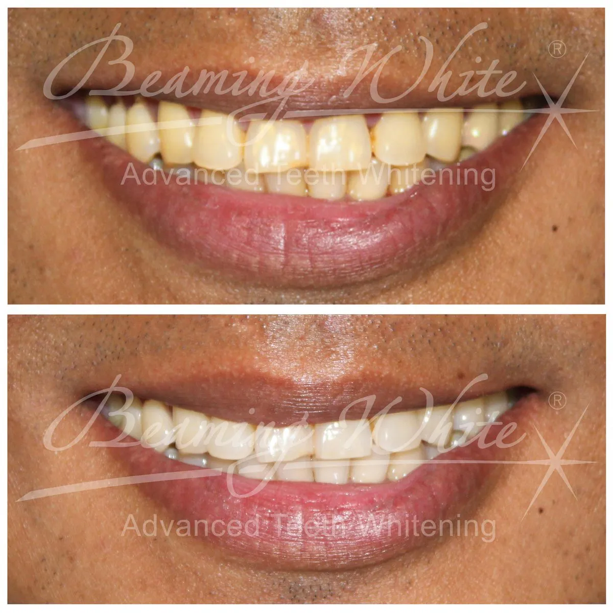 27085 teeth whitening procedures healthy diet