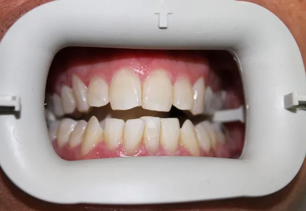 27085 teeth whitening procedures in office