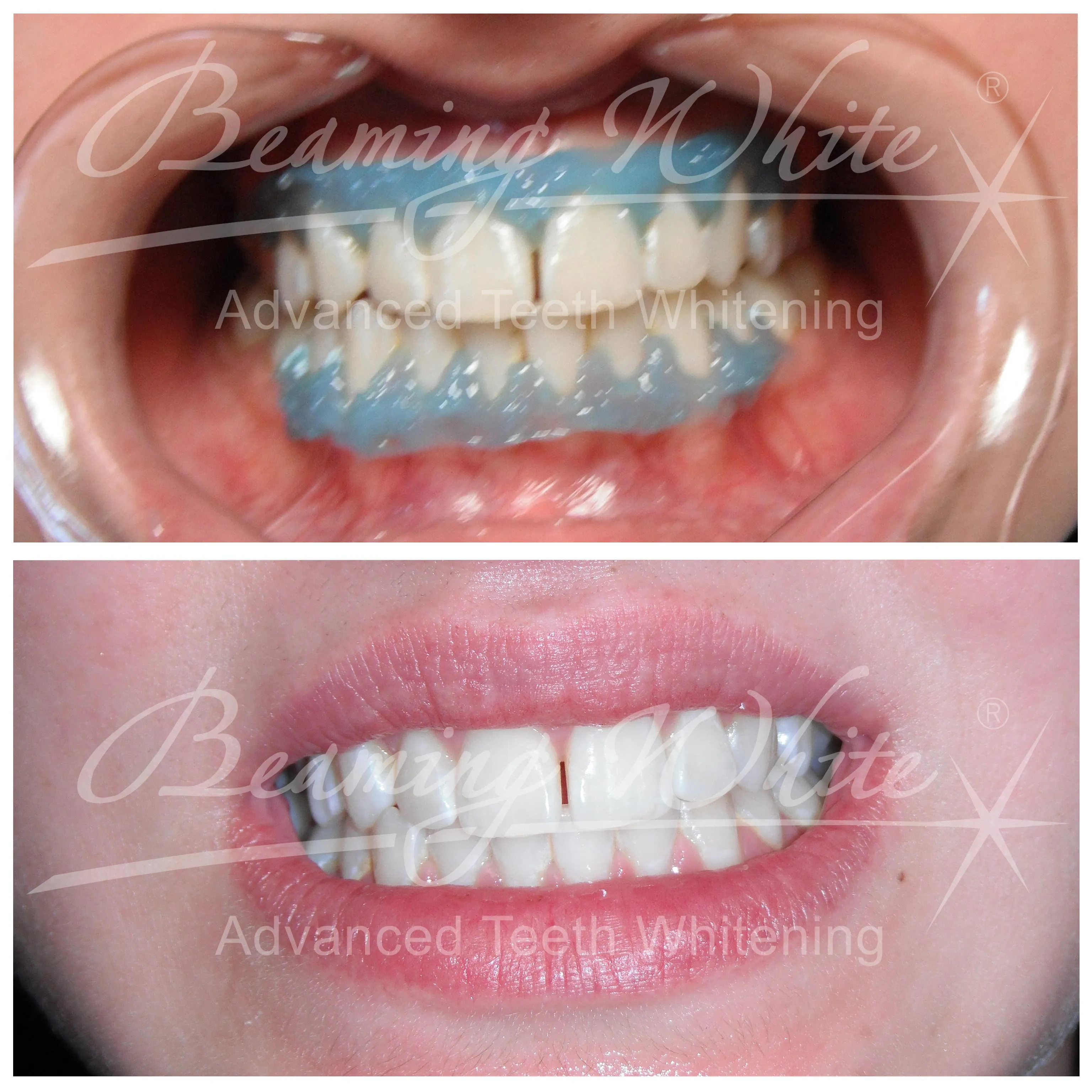 27085 teeth whitening procedures oral health