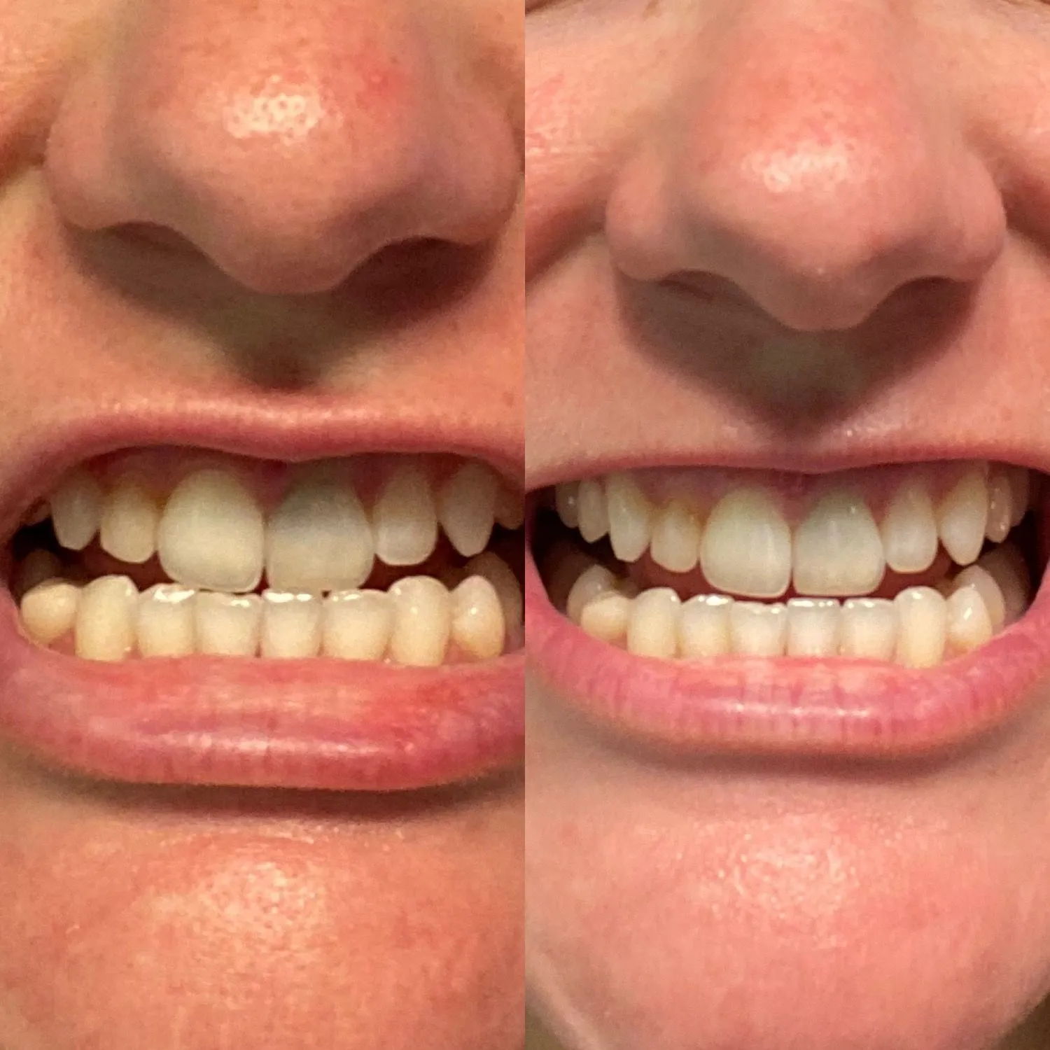 27095 hydrogen peroxide whitening
