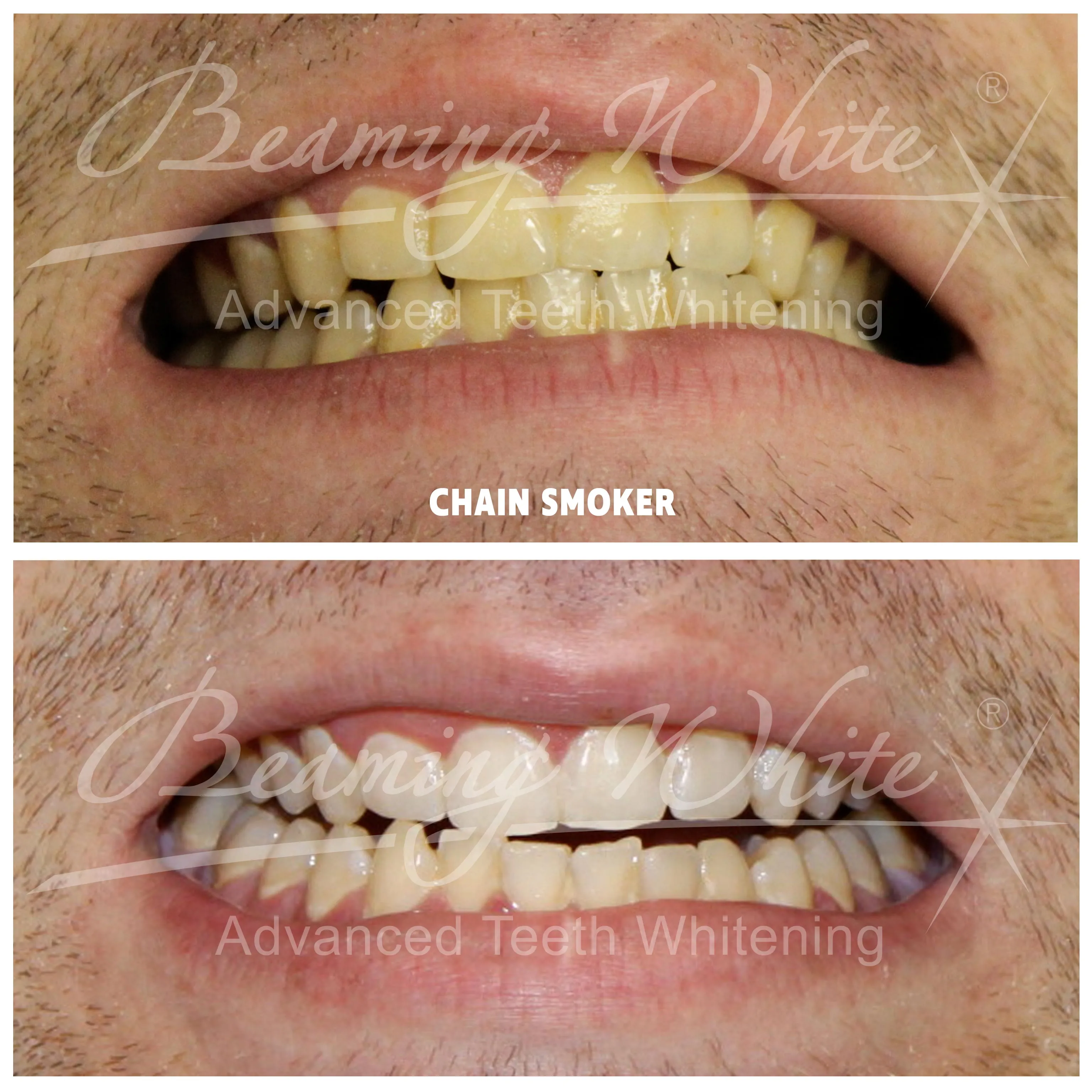27102 at home teeth whitening