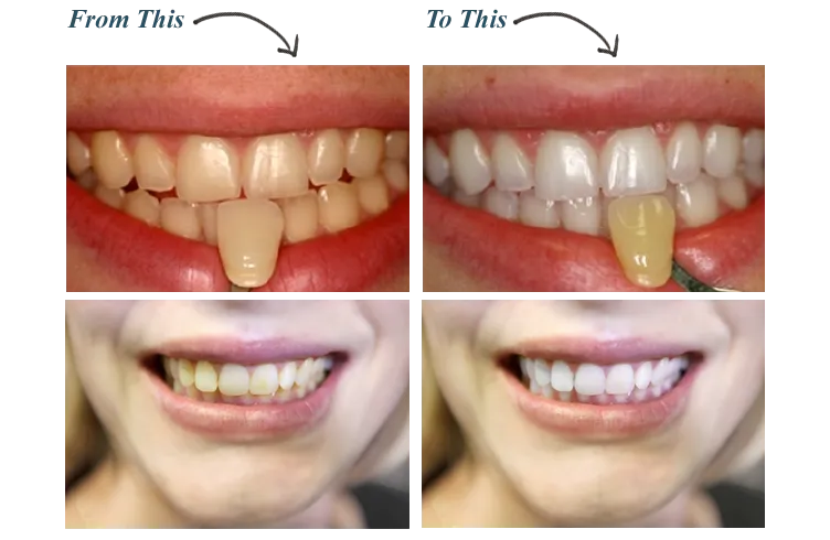27103 teeth whitening savannah professional